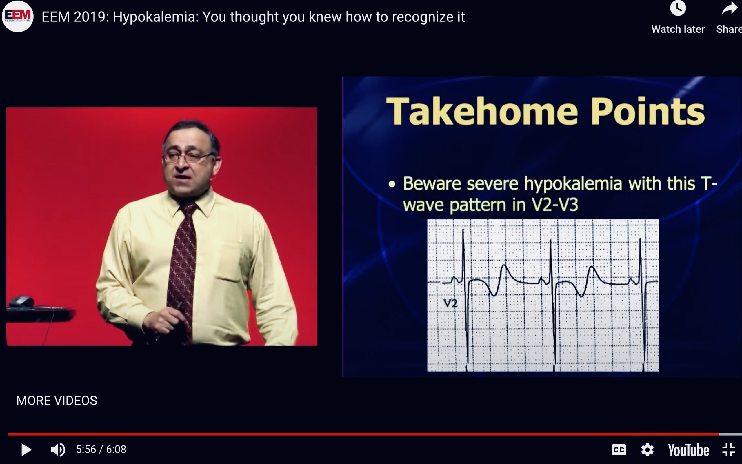 Severe Hypokalemia on EKG with Amal Mattu
